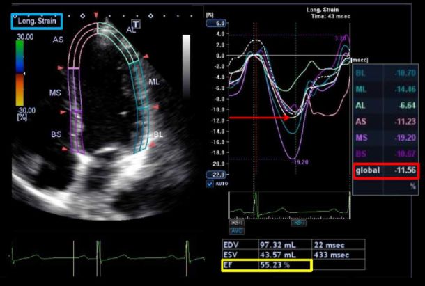 Myocardial-Strain